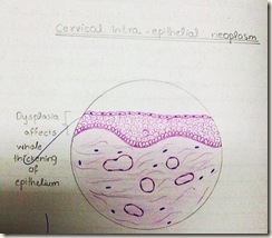 Histology Slides Database: PATHOLOGY hand made diagrams H ... cervix diagram 